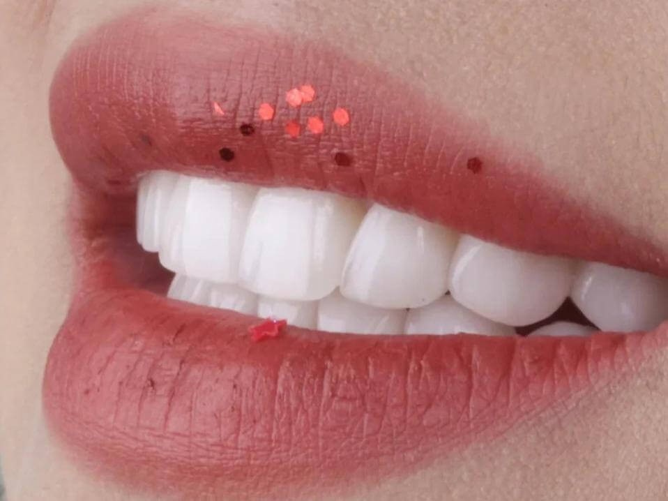 牙齒貼面能用多久？關鍵因素解析