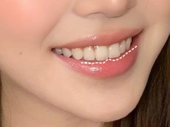 什麽情況適合做牙齒貼面？ 揭秘拯救笑容的秘密武器！