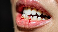 牙齒出血：不容忽視的口腔健康信號
