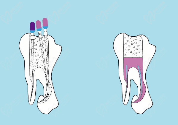 根管治療：拯救牙齒的最後防線