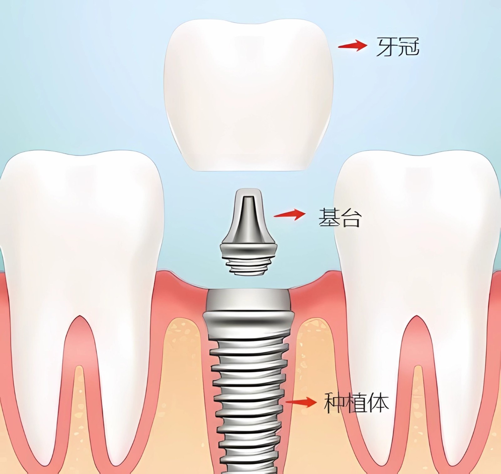 缺牙很多年還可以隨便去做種植牙嗎？