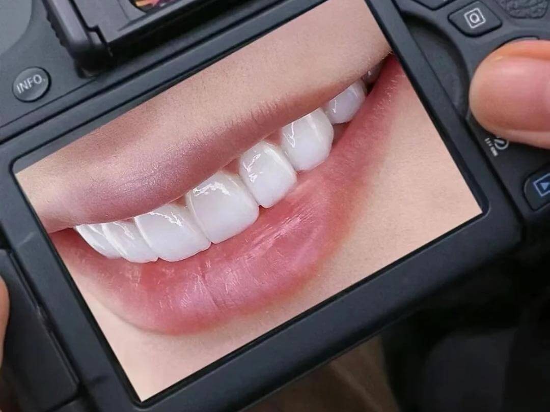 牙齒貼面全類型解析：選對材料才能美得更高級！