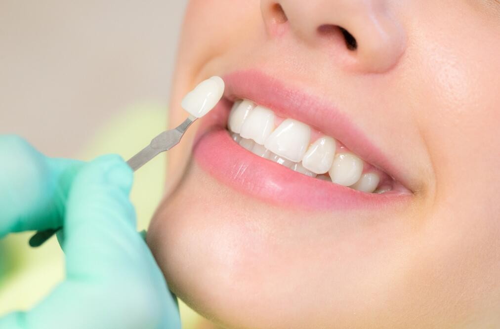 牙齒貼面有風險嗎？口腔醫生帶你科學避坑