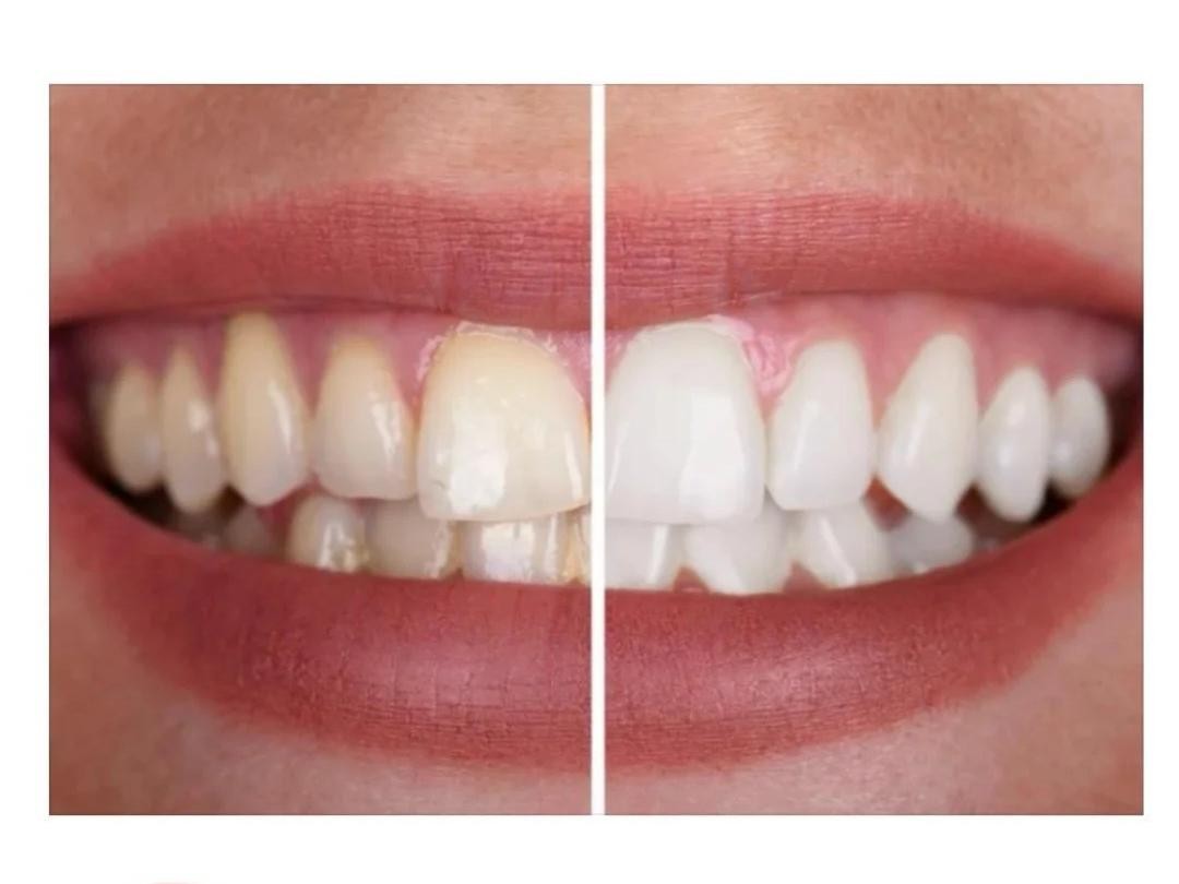 牙齒貼面需謹慎！5大缺點提前知