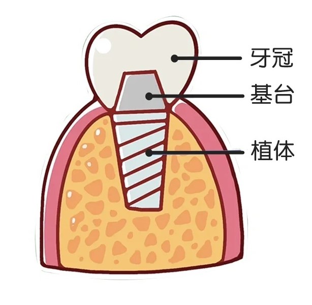 种植牙是用什么材料做的？_1_牙牙魔法师_来自小红书网页版