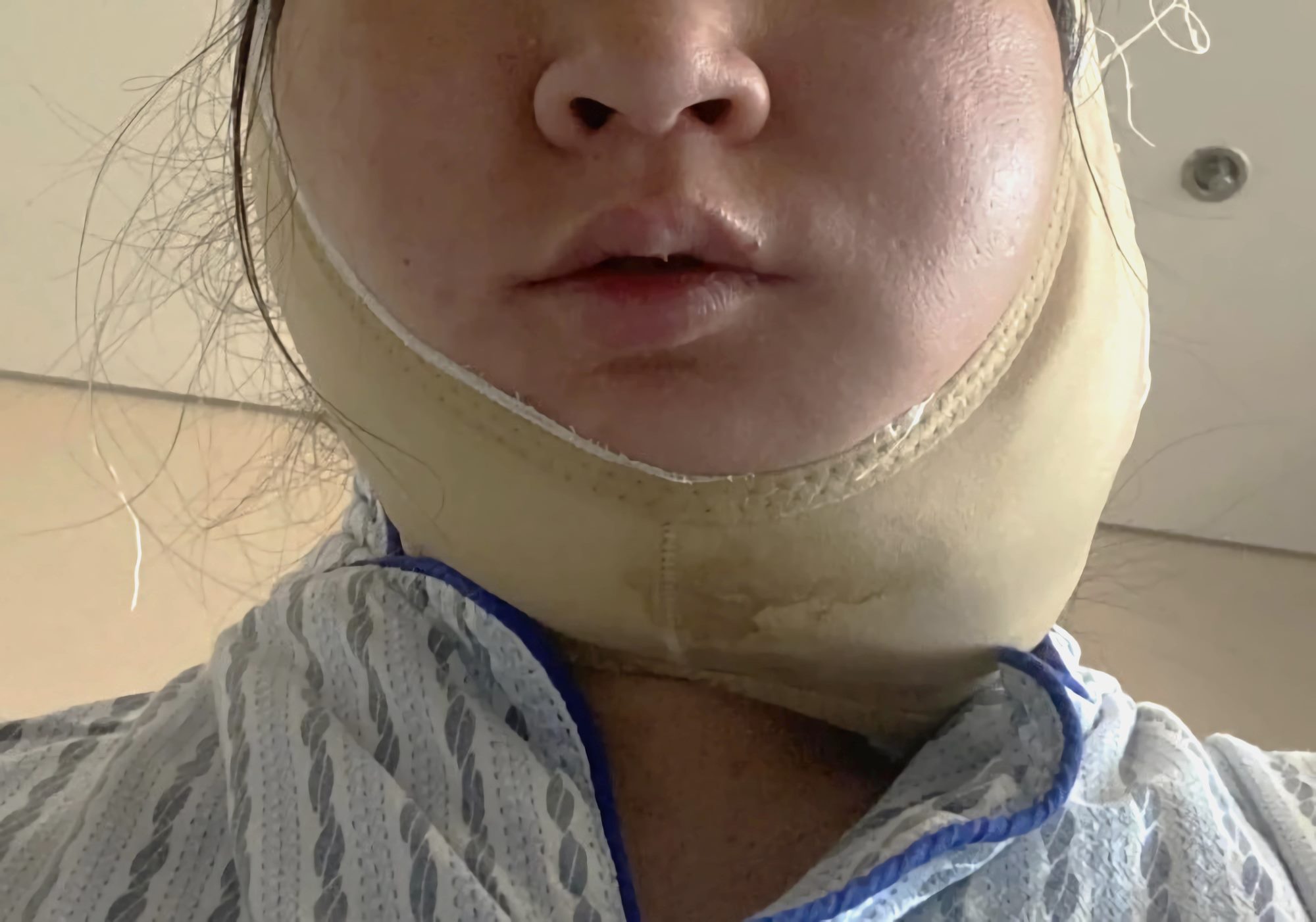 左下颌骨肿物取板_1_小红薯655EA371_来自小红书网页版 (1)