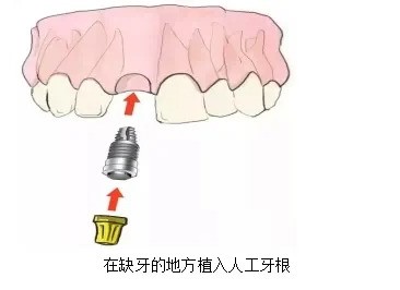 种牙您知道多少，您知道什么人适合种牙吗？_1_龅牙小兔兔_来自小红书网页版