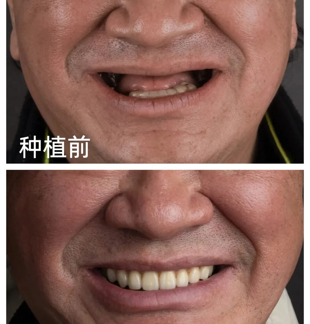 全口种植牙修复，一口牙等于一套房？?_1_种植牙连克乾｜牙媒_来自小红书网页版