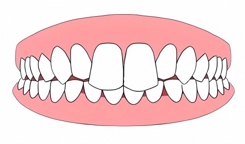 1-龅牙