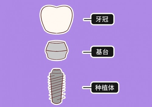种植牙的优点_1_福芽_来自小红书网页版