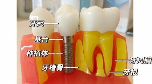 种植牙步骤_1_小红薯66F<span style=