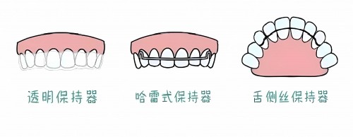 对比3种保持器优缺点，我们应该如何选？_5_牙齿矫正谌忠祚医生_来自小红书网页版 (1)